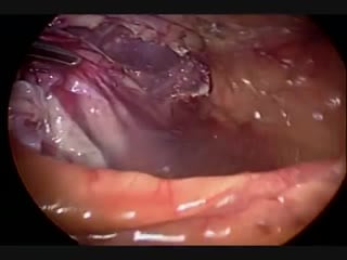 Резекция кисты почки