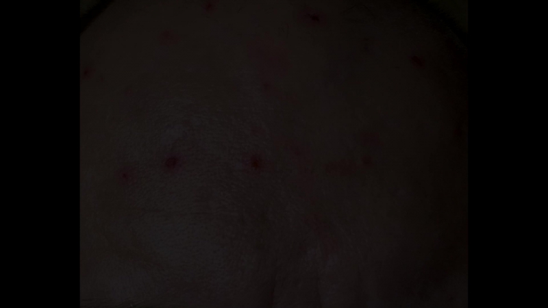 Hunting for acne/ experiment