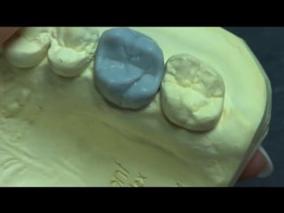 Live wax up upper 1st molar wax up( full )