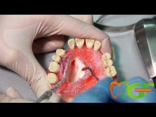 Хирургическая модель е04 gf dental