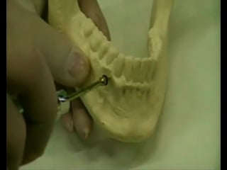 Mini implante hands on ортодонтия миниимпланты