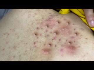 Спина с множеством угрей!