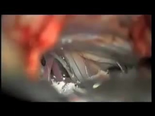 87 микроваскулярная декомпрессия лицевого нерва