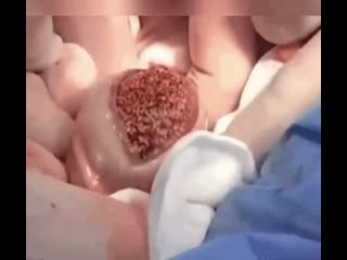 Удаление камня из мочевого пузыря