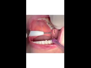 Удаление комков биша