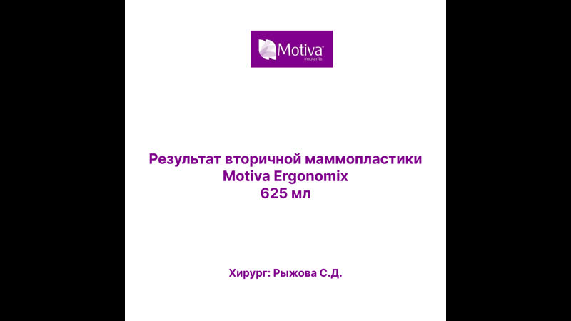 Результат вторичной маммопластики с motiva ergonomix 625 мл