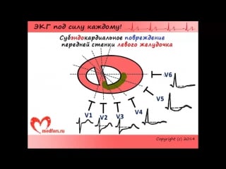 [10 экг под силу каждому] изменения экг при инфарктах, часть 2 локализация инфаркта