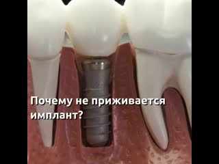 Почему не приживается имплант?