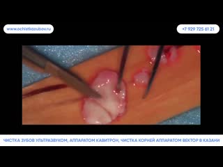 Ochistkazubov ru – проф чистка зубов в казани