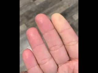 Явление рейно