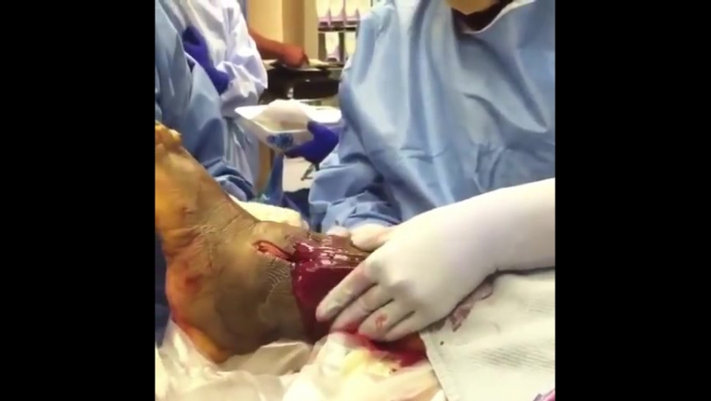 Абсцесс или флегмона?