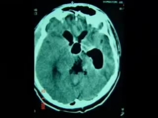 80 удаление опухоли (пинеоцитомы) пинеальной области