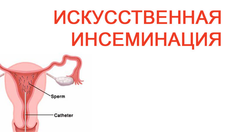 Искусственная инсеминация