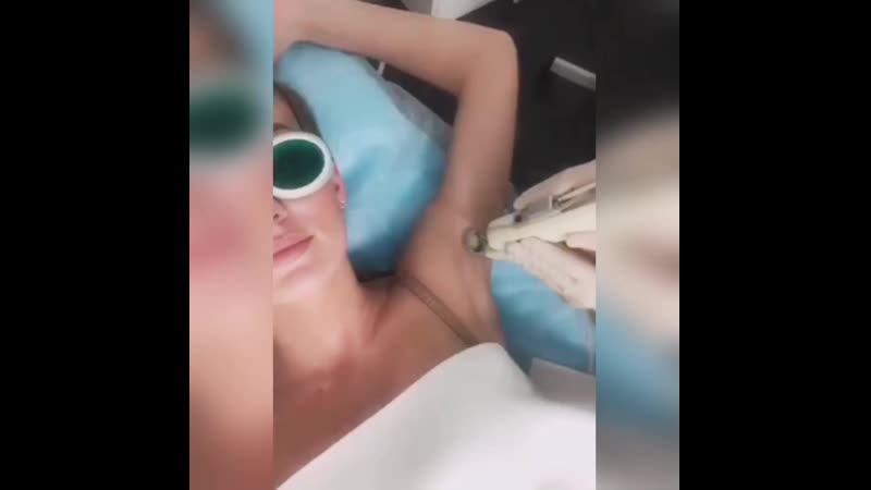 Лазерная эпиляция александритовым лазером