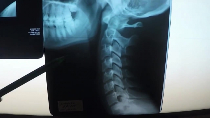 Миф про смещение позвонков! рентген шеи до и после праи лечение шеи ч 2