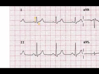 Ecg tutorial 2 interpreting the ecg