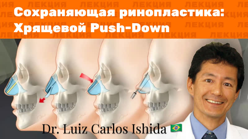 Push porn video – Сохраняющая ринопластика хрящевой push down
