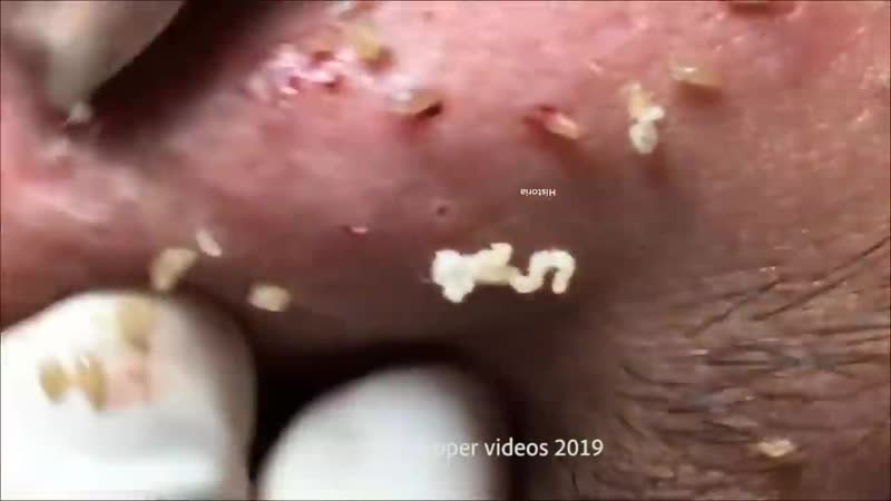 Воспаленные прыщи, корочки, черные точки