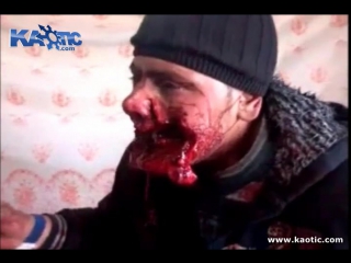 A round went through this mans mouth