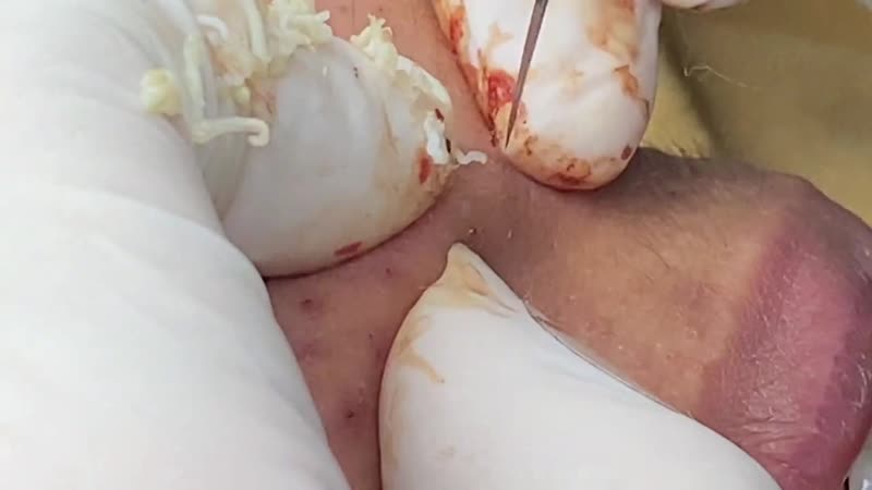 "тысяча выдавливаний" сезон 2, серия 3 из 3