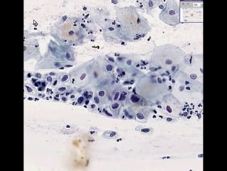 Cervix high grade squamous intraepithelial lesion (hsil), pap smear