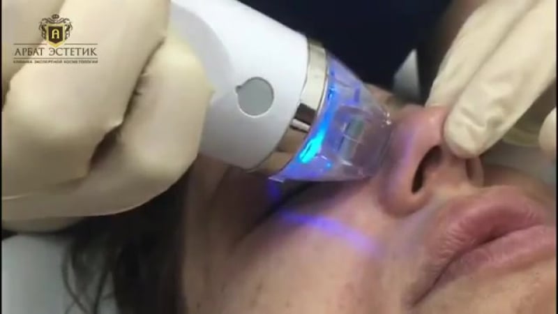Игольчатый rf лифтинг отзыв и впечатление пациента