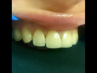 Эстетическая реконструкция верхних резцов 4 винирами из прессованной керамики ops e max