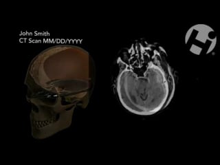 Growth of subdural hematoma with mass effect