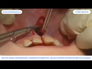 Ochistkazubov ru – чистка зубов аппаратом air flow в казани