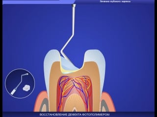 Глубокий кариес