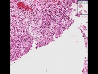 Skin or oral mucous membrane pyogenic granuloma