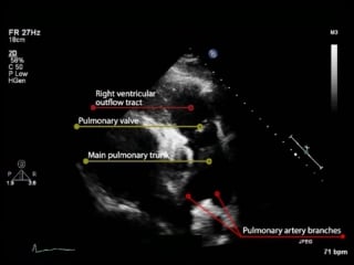 1a parasternal long axis view of the right ventricular outflow tract (normal)