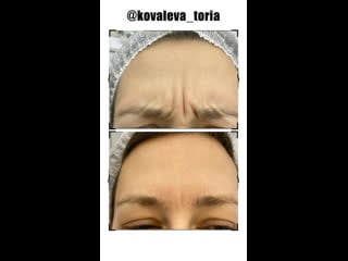 Ботулинотерапия