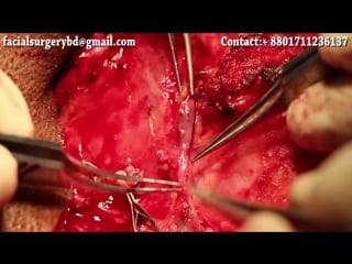 Амелобластома хирургия микрососудистая реконструкция стоматология dr abdullah al masud