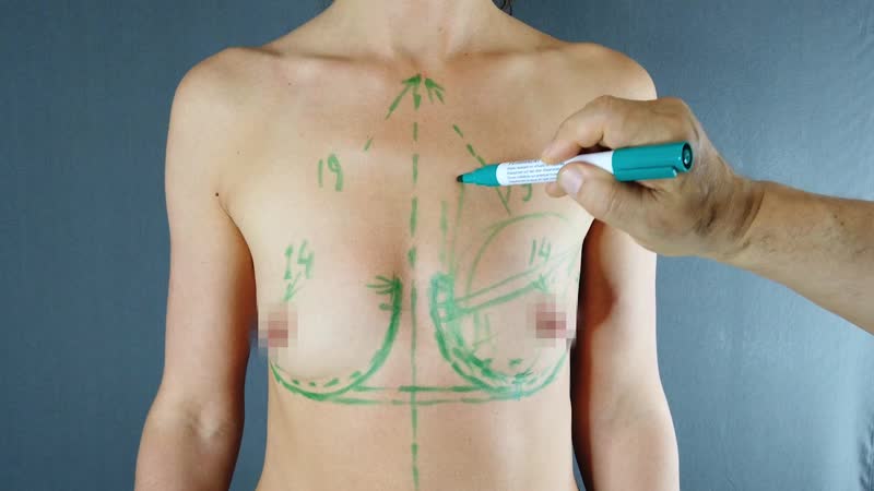 Разметка перед увеличением груди