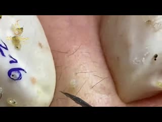 Молодые акне