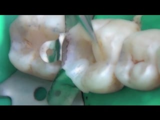 Everx posterior clinical video