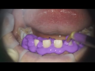 Veneer preparation workflow