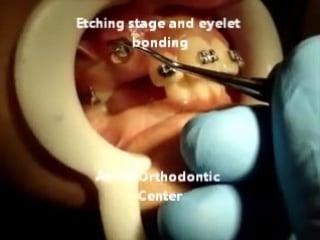 Canine exposure with diathermy (electrocautary) and orthodontic traction by asker ортодонтия