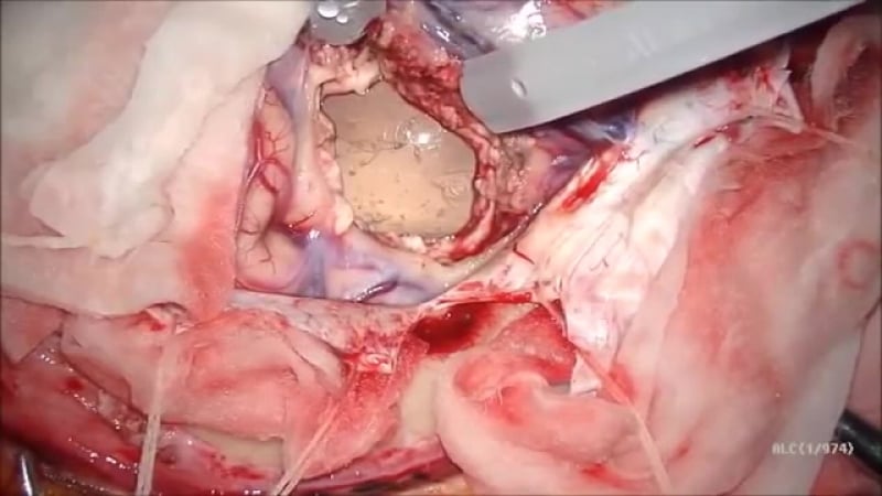 25 удаление эхинококкового пузыря головного мозга