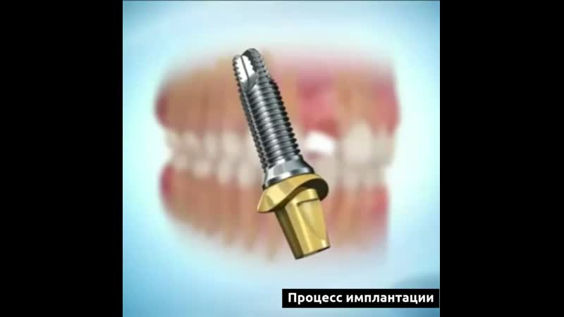 Имплант porn video – Что такое имплант?