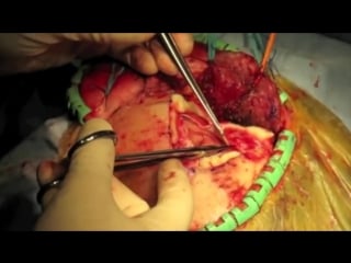 69 птериональная краниотомия (трепанация)