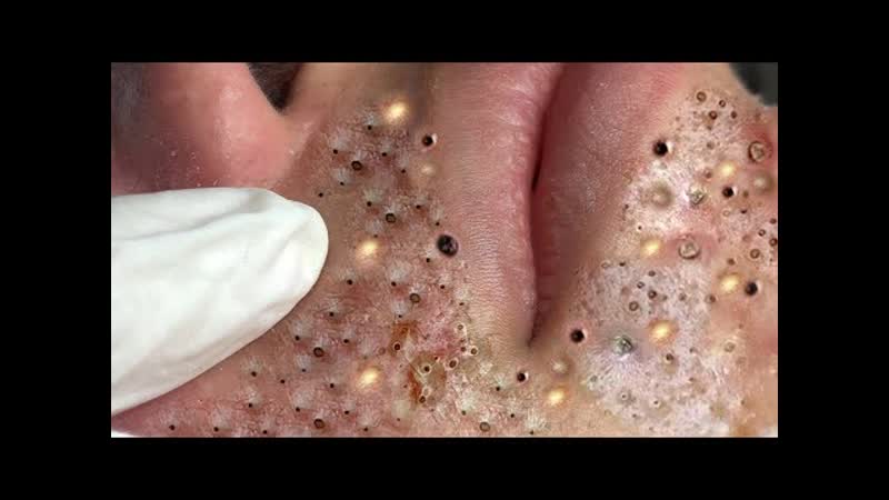 Очередное прекрасное лицо захотело выдавить свои прыщи на лице!