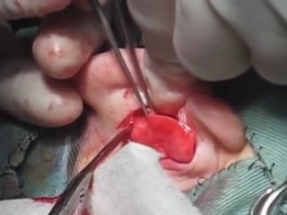 鼻尖縮小・鼻中隔延長のための耳介軟骨採取 graft surgery for tip