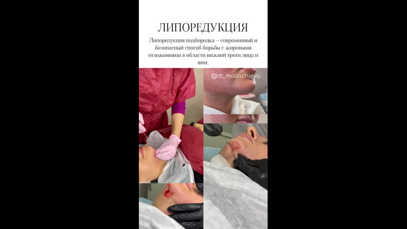 Липосакция подбородка