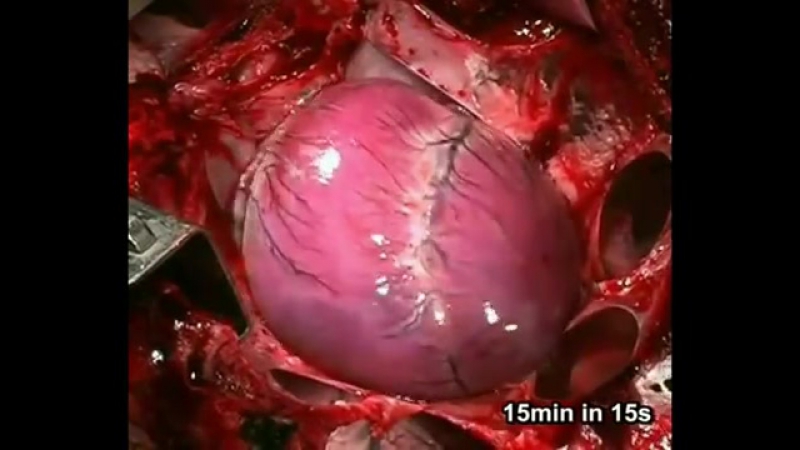 Сердечный приступ (видео в ускоренном режиме)