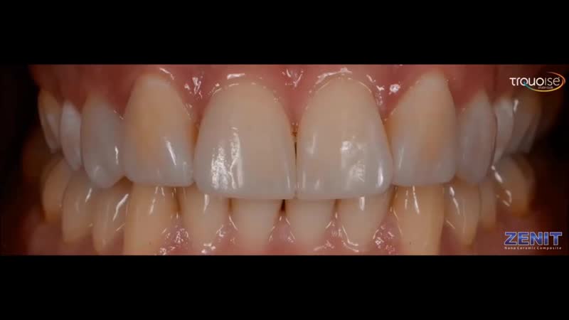 Zenit nano ceramic composite (president dental study club)