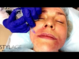 Biorevitalization stylage hydro and hydromax