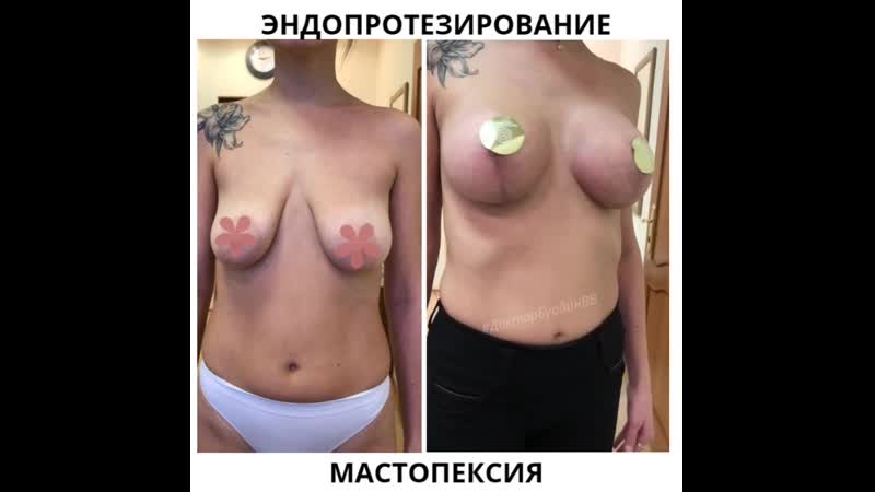Эндопротезирование молочных желез и мастопексия