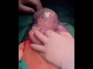 Чудо редких родов рождается без околоплодных вод!